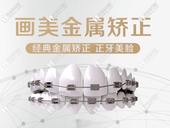 西安國產(chǎn)金屬自鎖和時代天使comfos隱形牙齒矯正價格表大全