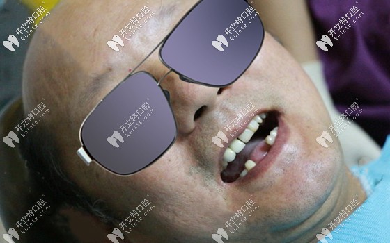 種植牙過程中的感受 種植牙過程中的感受