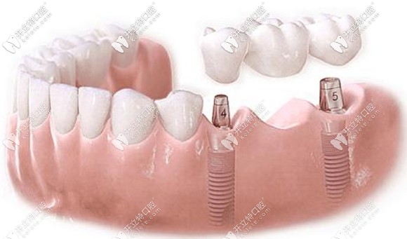 想讓種植牙為我們長(zhǎng)期服務(wù)離不開自己的細(xì)心呵護(hù)