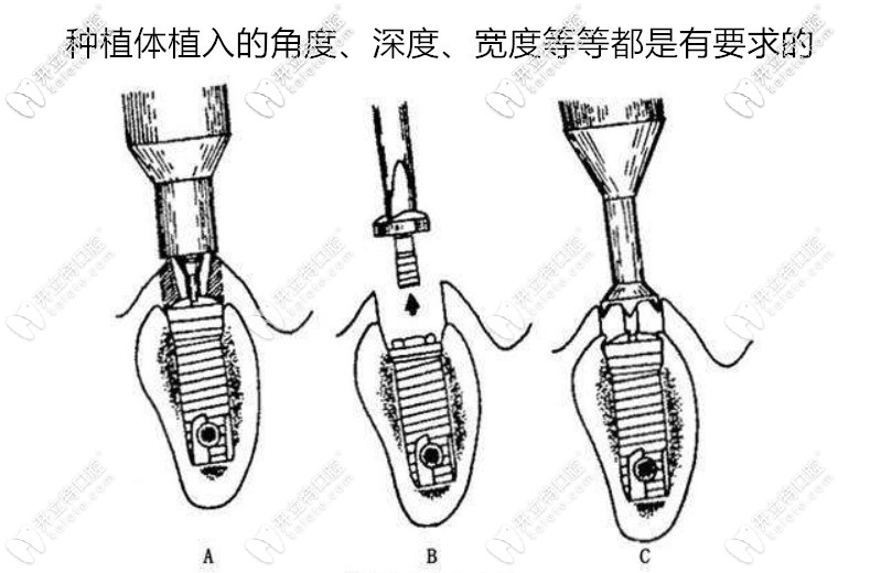 種植牙后牙床爛了可能是植體植入角度不對導(dǎo)致的