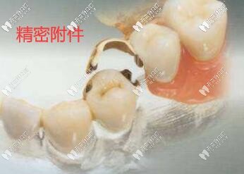 精密附著體義齒