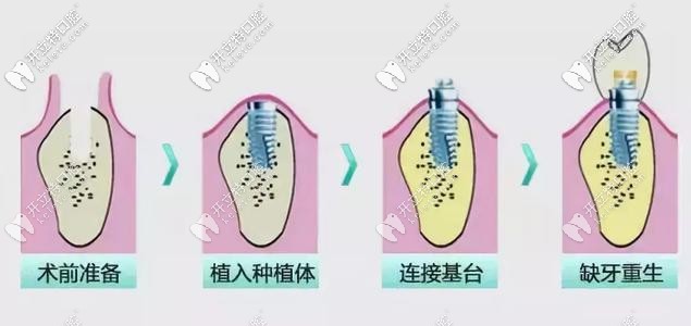 種植牙的過程