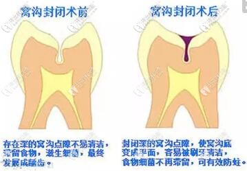 窩溝封閉圖片