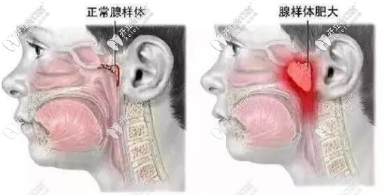 腺樣體肥大