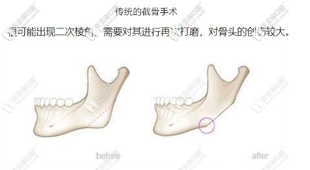 做之前要對(duì)目前主流的正頜手術(shù)方法進(jìn)行了解