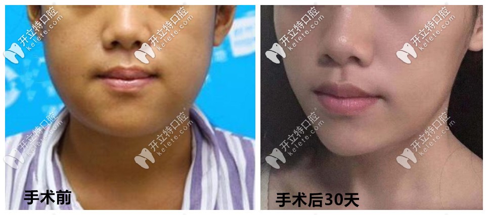 骨性地包天手術(shù)前后效果對(duì)比圖