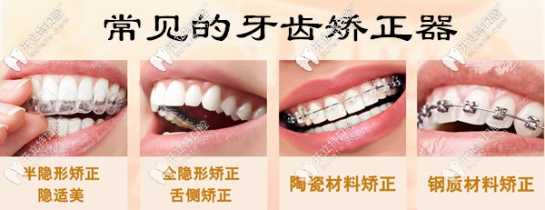 蘇州地區(qū)常用的牙齒矯正器