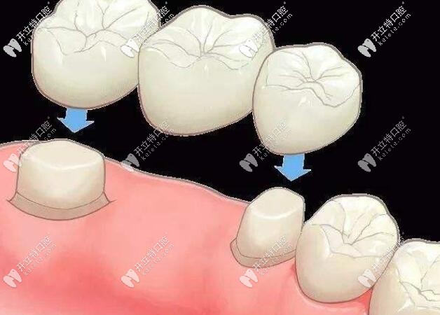 烤瓷冠安裝示意圖
