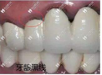 烤瓷牙基牙腐爛一摸手都是臭的,分享拆烤瓷牙的過(guò)程圖片