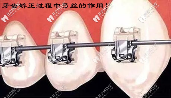 千萬別小瞧了牙齒矯正過程中弓絲的作用和原理