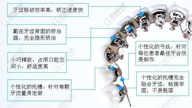 舌側(cè)矯正優(yōu)勢(shì)