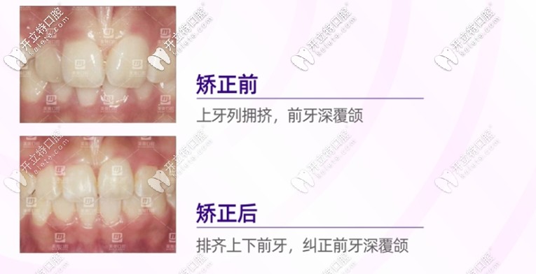 重慶美奧口腔齙牙矯正前后對(duì)比圖