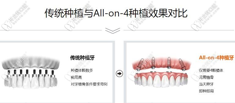 ALL-on-4即刻負重種植牙優(yōu)勢