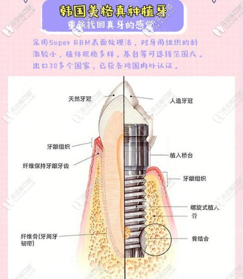 深圳河山口腔韓國(guó)美格真進(jìn)口種植牙特點(diǎn)