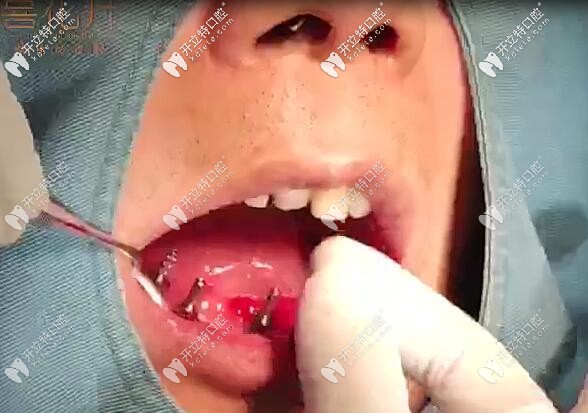 <!--<i data=20240703-sp></i>-->口腔半口即刻負重種植牙<span style= <!--<i data=20240703-sp></i>-->口腔半口即刻負重種植牙<span style=