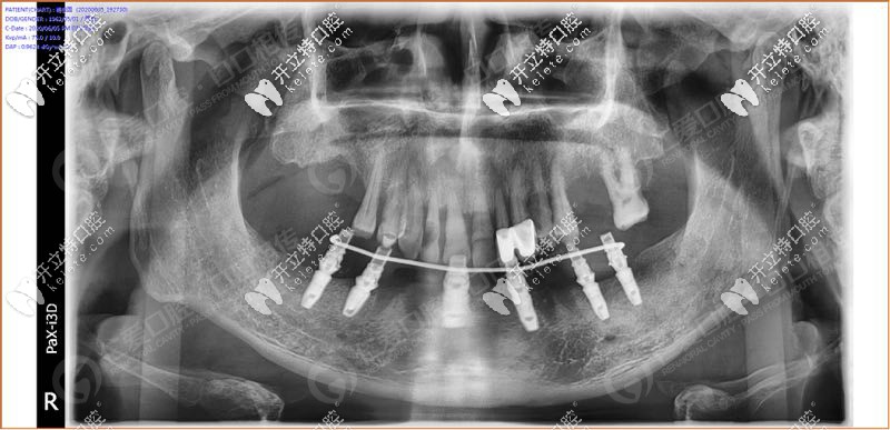 <!--<i data=20240703-sp></i>-->口腔all-on-6半口種植牙真人<span style= <!--<i data=20240703-sp></i>-->口腔all-on-6半口種植牙真人<span style=