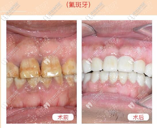武漢仁愛口腔武漢小伙氟斑牙做義獲嘉超薄瓷貼面美白經(jīng)歷,在乎價格的進(jìn)