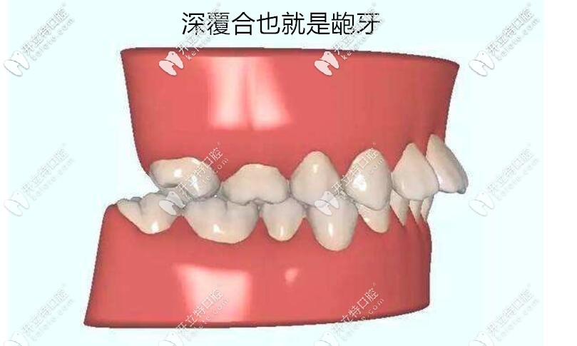 北京國(guó)醫(yī)康口腔苑主任來(lái)告訴大家純股型齙牙是需要做手術(shù)的矯正無(wú)效