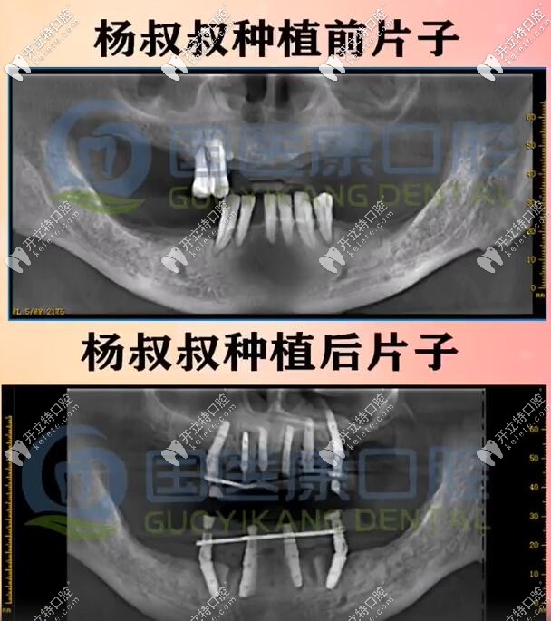 71歲楊叔做一日得全口種植牙種了10顆植體，上半口6下半口4