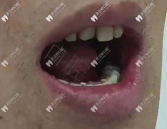 <!--<i data=20240703-sp></i>-->口腔半口all-on-6登騰即刻負重種植牙<span style= <!--<i data=20240703-sp></i>-->口腔半口all-on-6登騰即刻負重種植牙<span style=