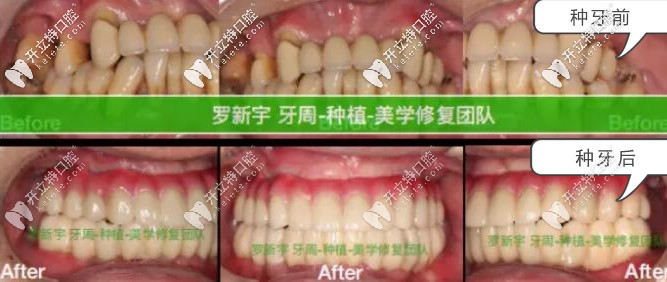 無錫美奧口腔重度牙周炎患者種牙前后對比照片