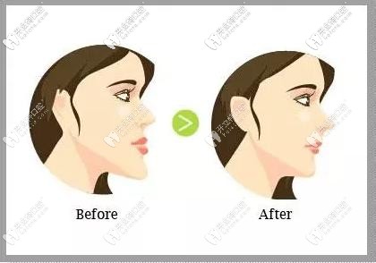 正頜對面部改善較大