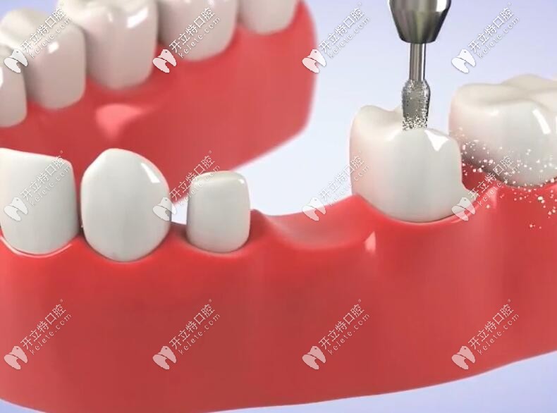 牙齒搭橋會(huì)損壞好牙