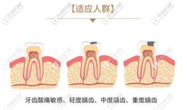 3M補牙適宜人群