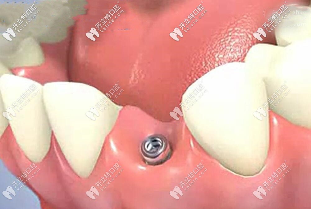 種植牙不會(huì)傷害臨牙