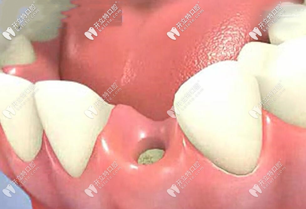 種植牙手術(shù)全過(guò)程演示