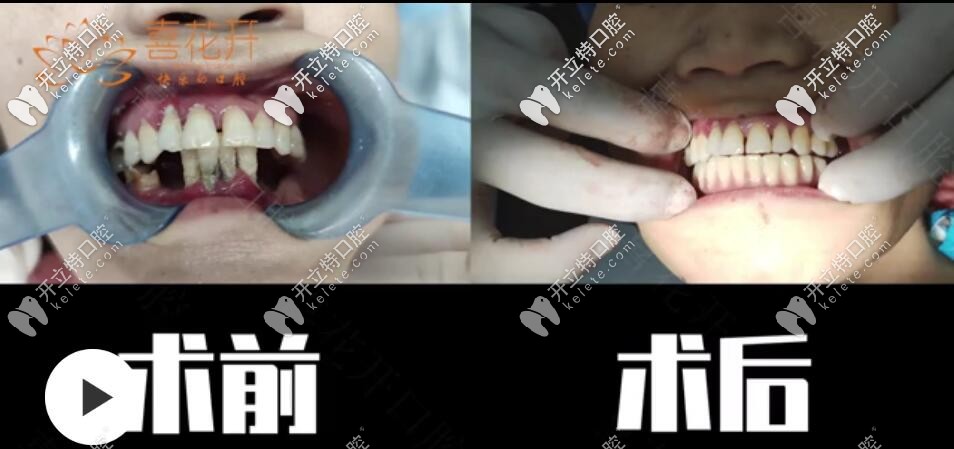 <!--<i data=20240703-sp></i>-->口腔即刻負(fù)重種植牙<span style=