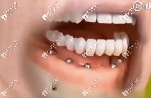 即刻負(fù)重種植牙