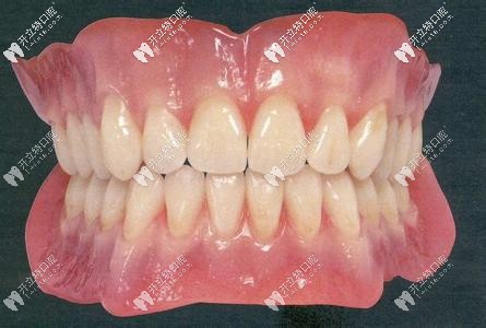 活動(dòng)假牙外觀