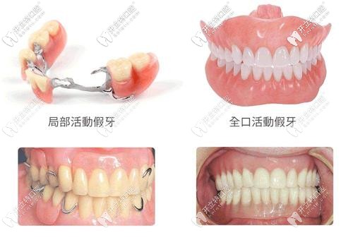 不同的假牙類(lèi)型
