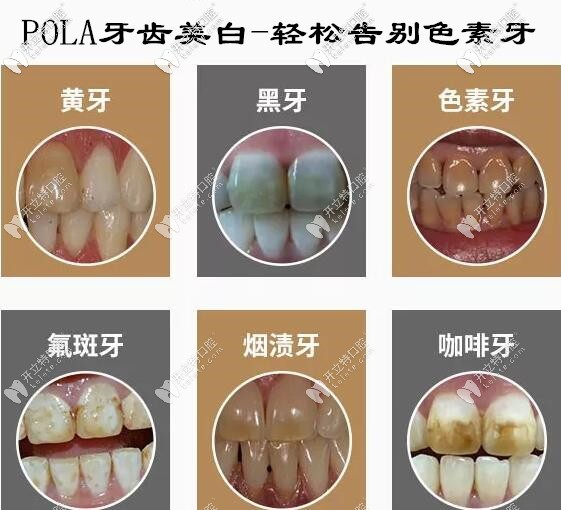 澳大利亞pola牙齒美白診室裝和家庭裝的步驟