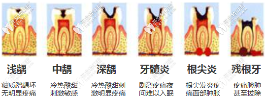 齲齒的不同等級(jí)