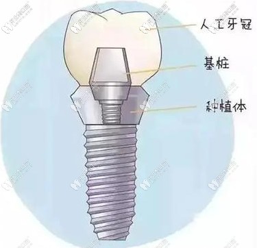 初期穩(wěn)定性對(duì)種植體的壽命有影響