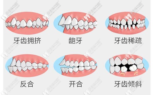 牙齒矯正適應(yīng)癥