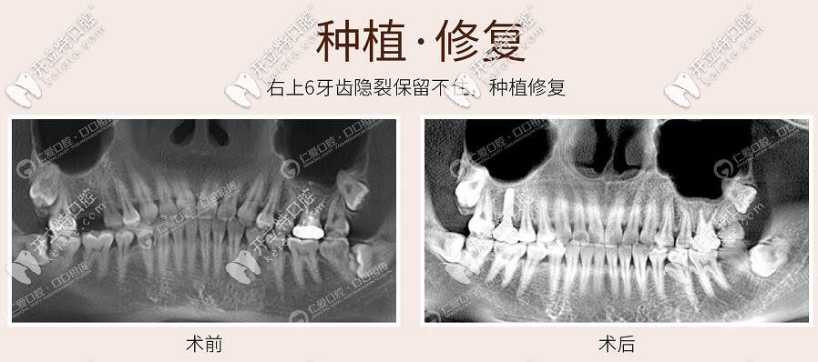 <!--<i data=20240703-sp></i>-->醫(yī)院口腔科法國安卓健種植牙案例