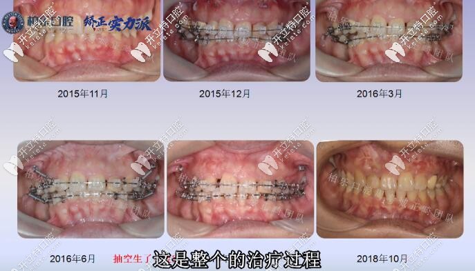 南寧柏樂后牙缺失三顆大牙案例整個(gè)治療過程