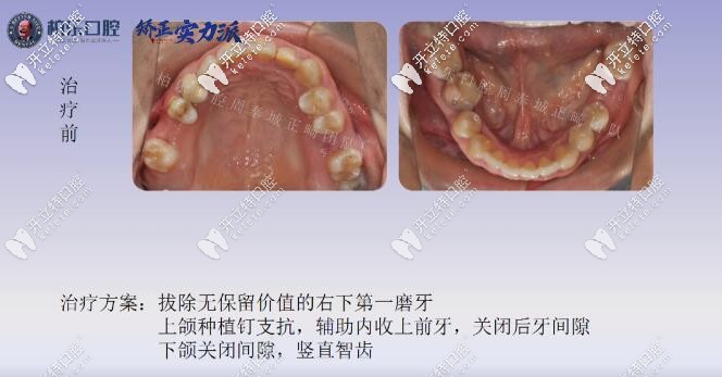 南寧柏樂口腔缺失三顆矯正方案