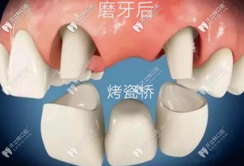 缺牙修復烤瓷橋