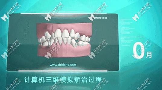 數(shù)字化隱形矯正的矯治過程