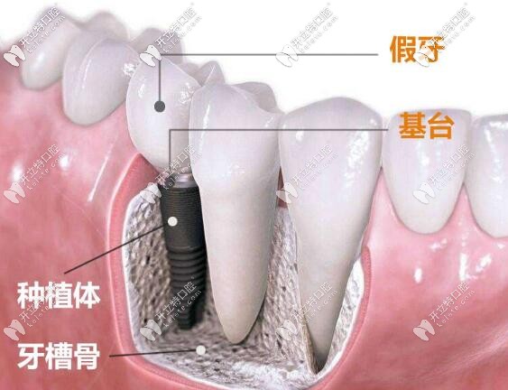 長沙美奧種植牙價(jià)格表查詢:美奧口腔技術(shù)好價(jià)格也才3980一顆