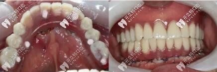 3d導(dǎo)板all-on-6即刻種植牙當(dāng)天恢復(fù)全口,價(jià)格10多萬是有道理的 