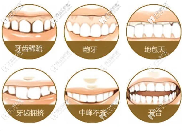 牙齒不齊的類型