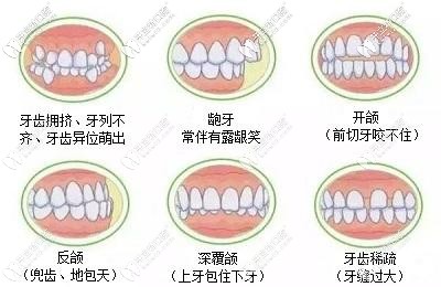 鋼牙套針對(duì)病例更廣