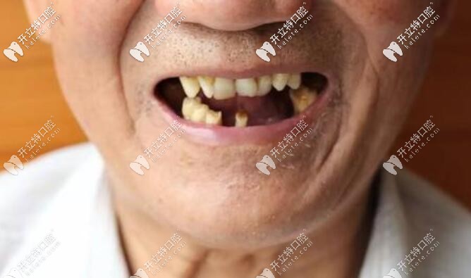 孫玉楓說70、80歲老人種牙好還是鑲牙好