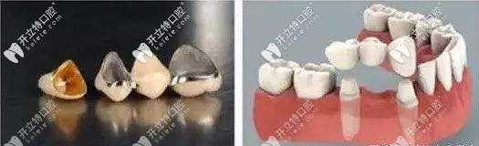 固定義齒