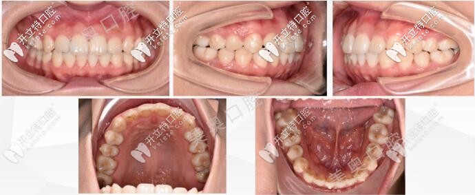 無錫美奧口腔牙齒矯正后的圖片